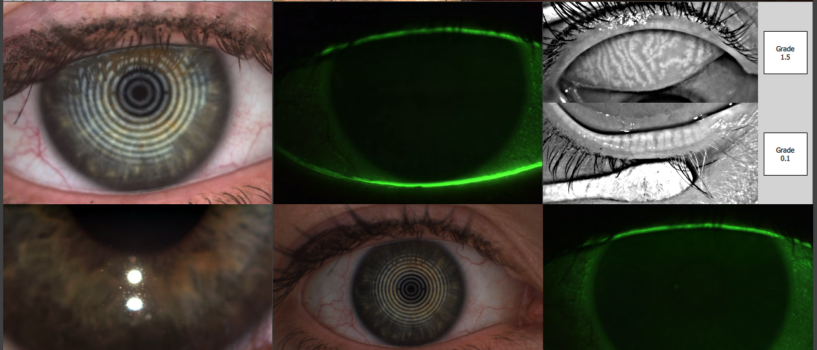 Dry eye Banner2